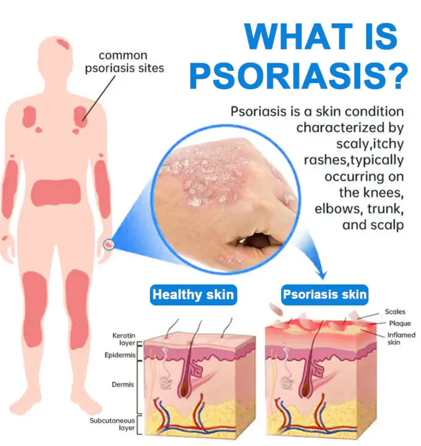 Magnesium Herbal Psoriasis Spray - Image 10