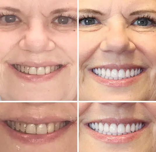 - Premium Denture - Image 6
