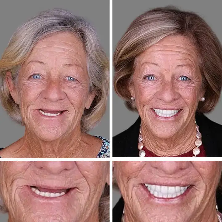 🔥🔥Enjoy a 70% discount today! 🦷 custom dentures for greater confidence.🔥Stop immediately - Image 7