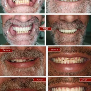 FLASH SALE: Fix Your Smile in 30 Seconds — 👨⚕Adjustable SnapOn Dentures😁 - Image 3