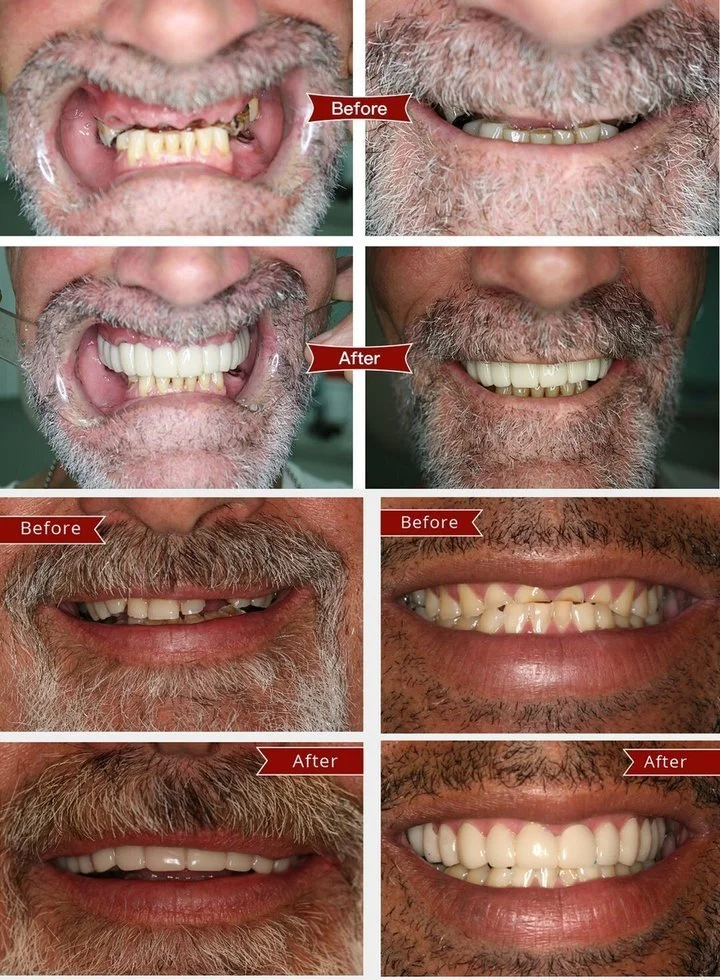 FLASH SALE: Fix Your Smile in 30 Seconds — 👨⚕Adjustable SnapOn Dentures😁 - Image 3