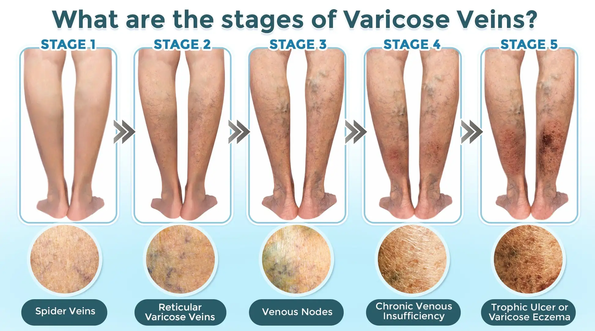 VenaRestore MicroNeedle Vein Repair Patch - Image 5