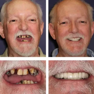 -Advanced Custom-Fit Functional Dentures - Image 9