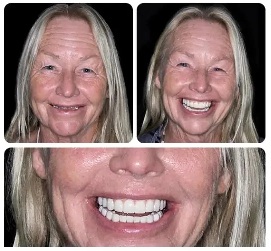 -Advanced Custom-Fit Functional Dentures - Image 8