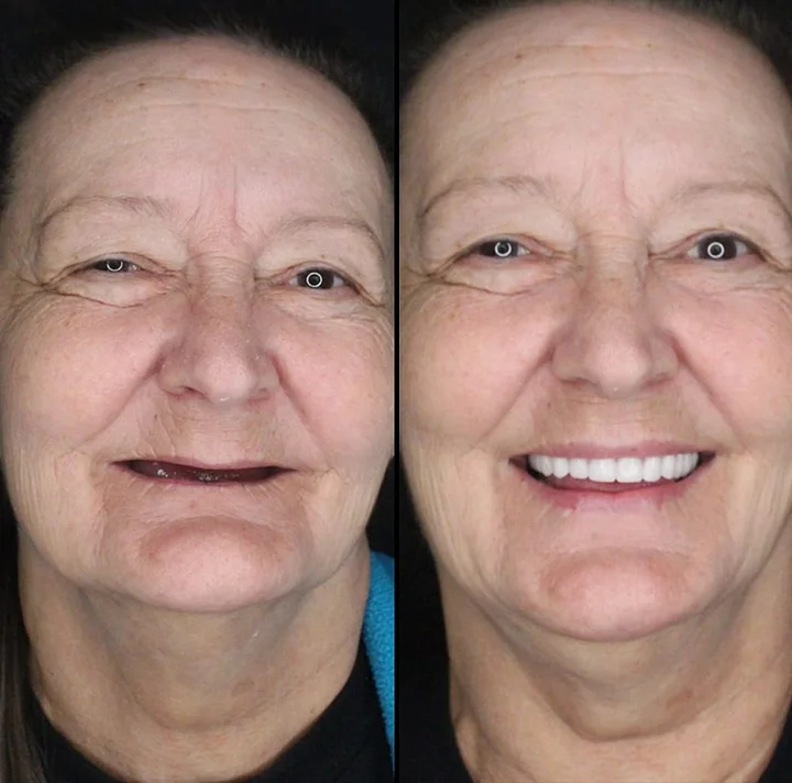 -Advanced Custom-Fit Functional Dentures - Image 7