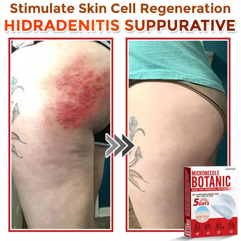 MicroNeedle Botanic Skin Tag Removal Patch - Image 10