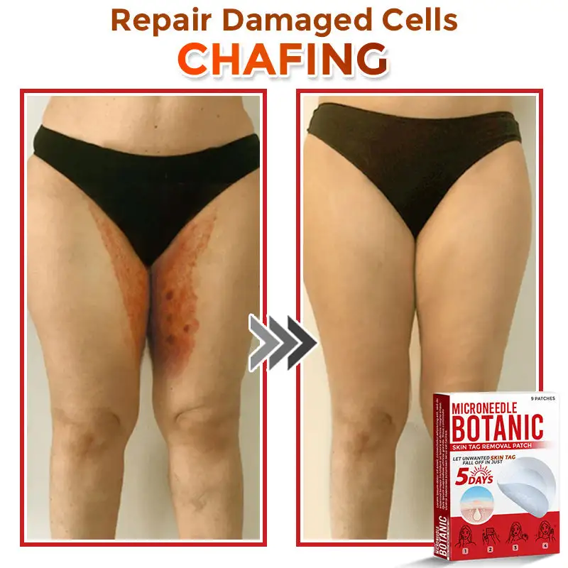 MicroNeedle Botanic Skin Tag Removal Patch - Image 5