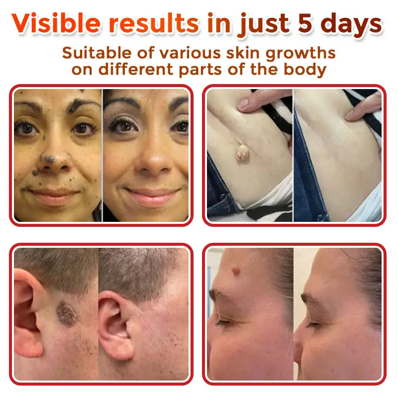 MicroNeedle Botanic Skin Tag Removal Patch - Image 12