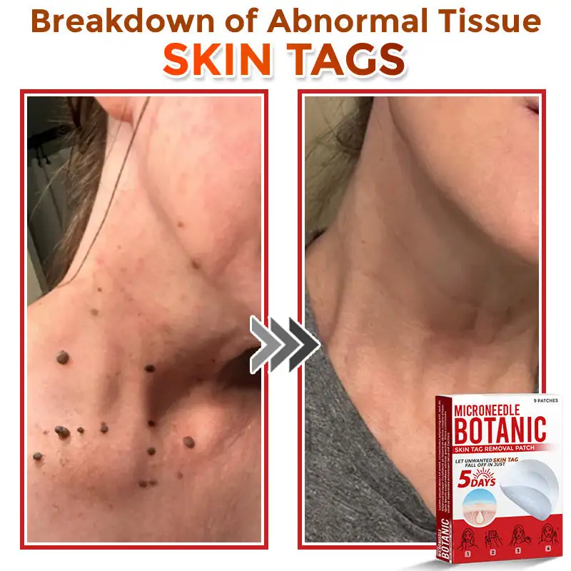 MicroNeedle Botanic Skin Tag Removal Patch - Image 4