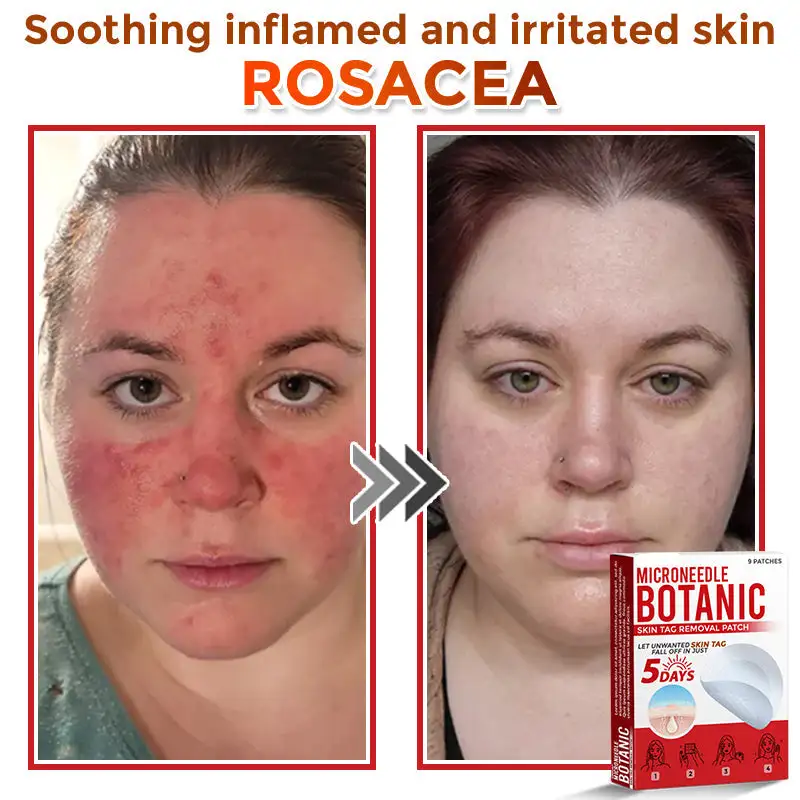 MicroNeedle Botanic Skin Tag Removal Patch - Image 3
