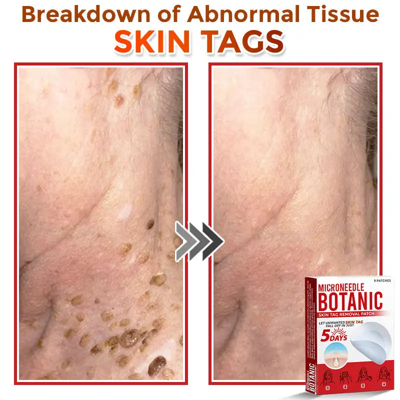 MicroNeedle Botanic Skin Tag Removal Patch - Image 2