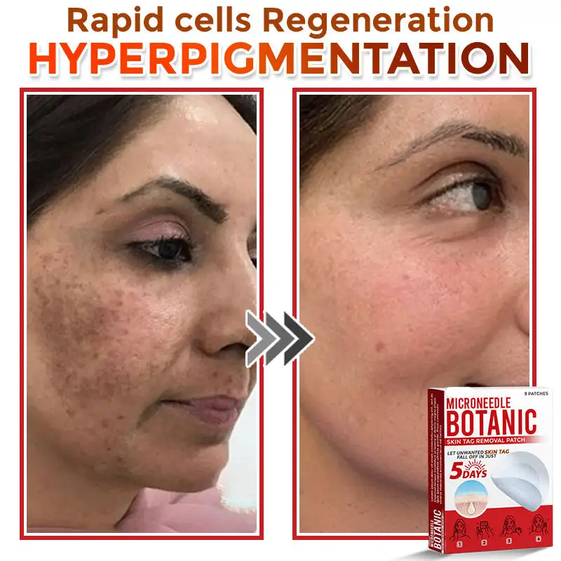 MicroNeedle Botanic Skin Tag Removal Patch - Image 8