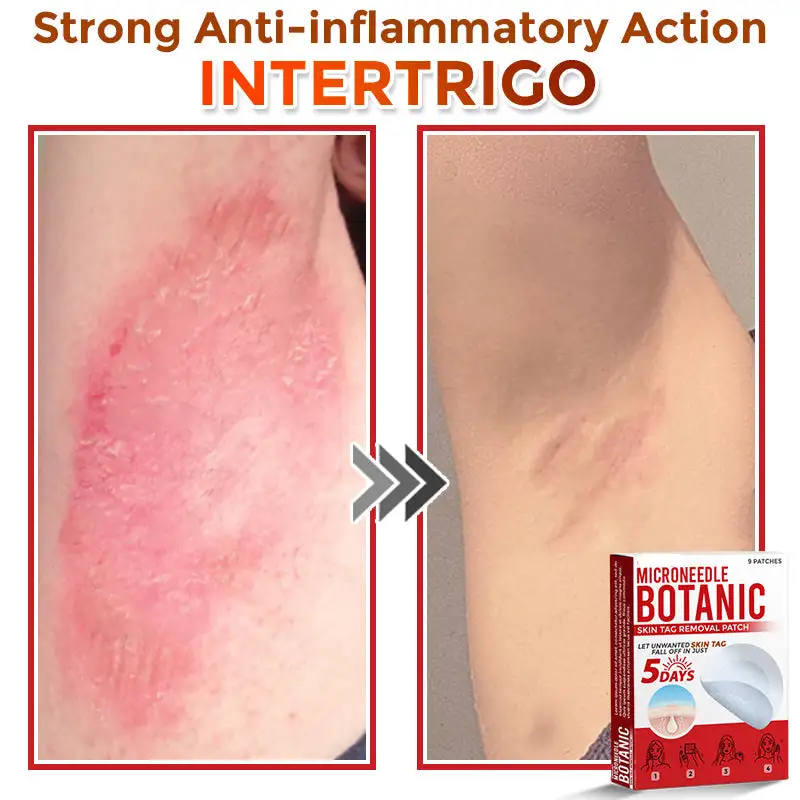 MicroNeedle Botanic Skin Tag Removal Patch - Image 7