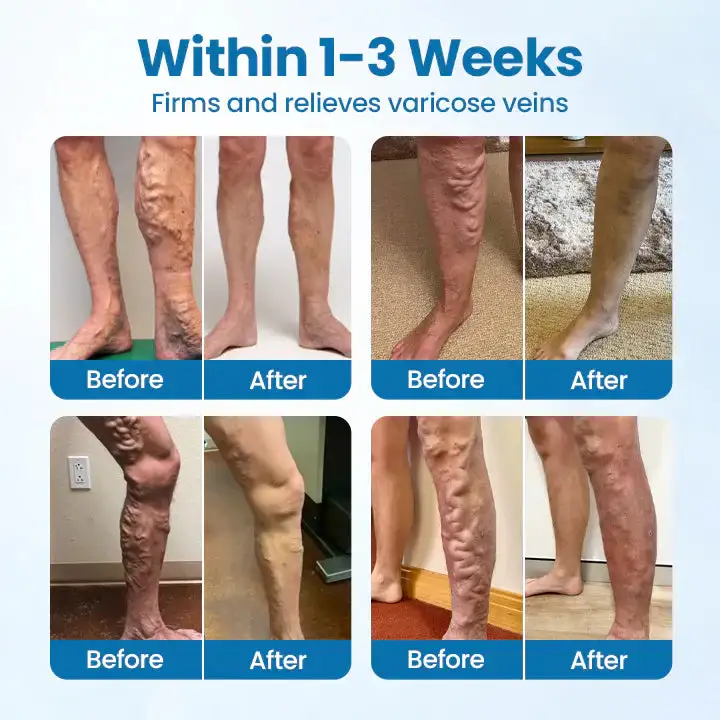 Leg Relief Varicose Veins Cream 50g – Natural Body Care Lotion to Soothe Pain, Reduce Swelling, Improve Circulation & Support Healthy, Comfortable Skin - Image 2