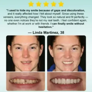 Instant Stick-on Dental Veneers - Image 5