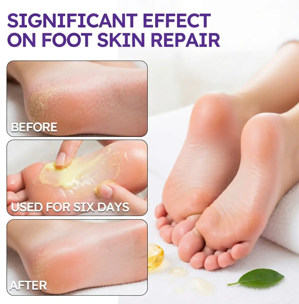 🎁 Limited-Time Offer 🎁 - Don't miss out!Tea Tree Oil Foot Cream (Repairs Dry Cracked Heels, Soothes Tired Feet, Eliminates Odor & Restores Soft Skin) - Image 6