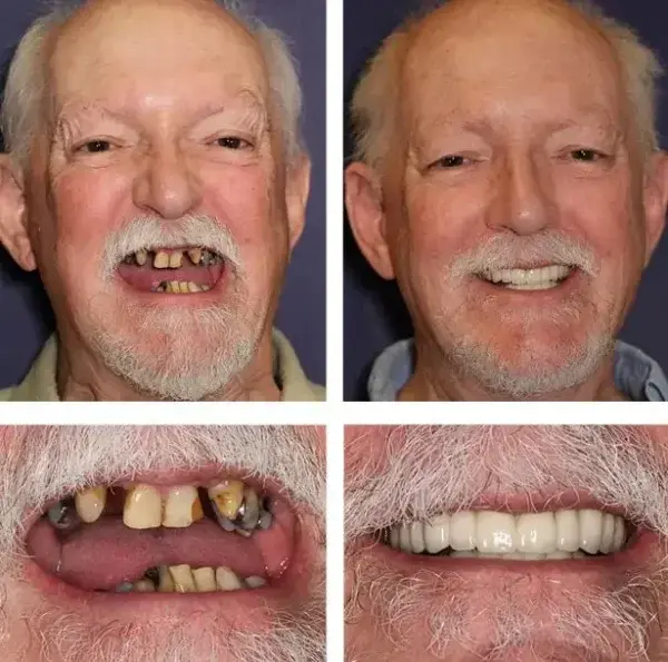 Custom-Fit Functional Dentures — Combination pack - Image 5