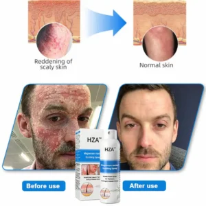 Magnesium Herbal Psoriasis Spray - Image 11