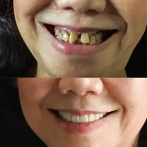 SmileFitPro BioFusion Dentures - Image 11