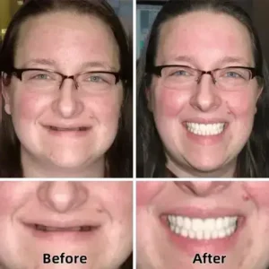 –Advanced Custom-Fit Functional Dentures - Image 5