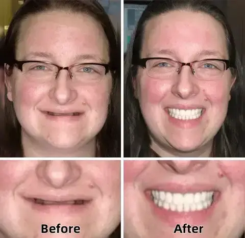 –Advanced Custom-Fit Functional Dentures - Image 5