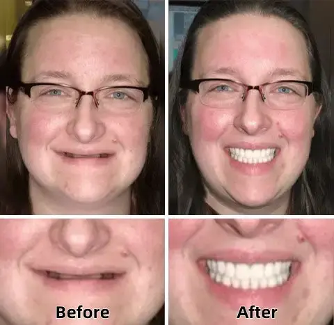 –Advanced Custom-Fit Functional Dentures - Image 5