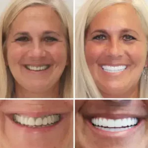 -🦷Advanced Customized Full Denture Set🦷 (⏰Limited time discount last 30 minutes⏰) - Image 5