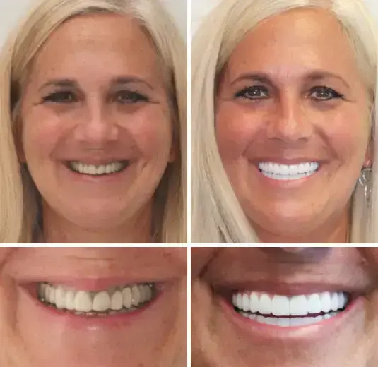 -🦷Advanced Customized Full Denture Set🦷 (⏰Limited time discount last 30 minutes⏰) - Image 5