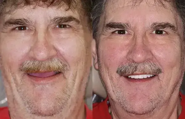 -🦷Advanced Customized Full Denture Set🦷 (⏰Limited time discount last 30 minutes⏰) - Image 9