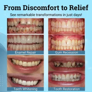Smileasego NonSurgical Gum "Suture" Gel - Image 2