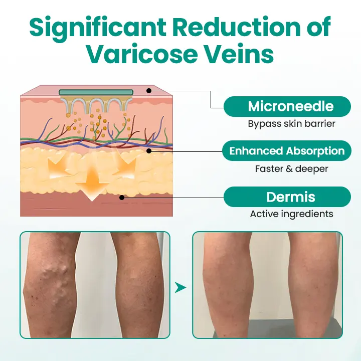 LegRenew Varicose Veins Patch - Image 5