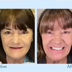 Dentures - Image 10