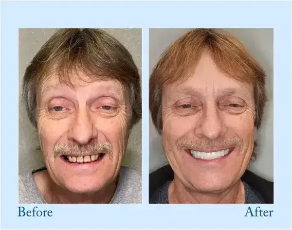 Dentures - Image 9