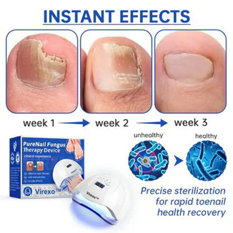 PureNail Fungus Laser Device - Image 8