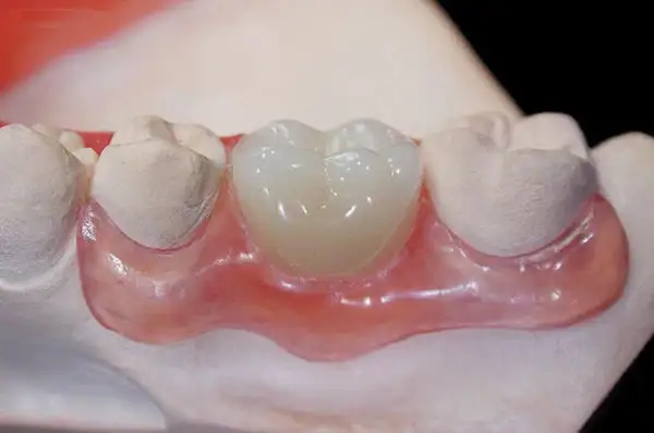 Premium Denture - Image 5