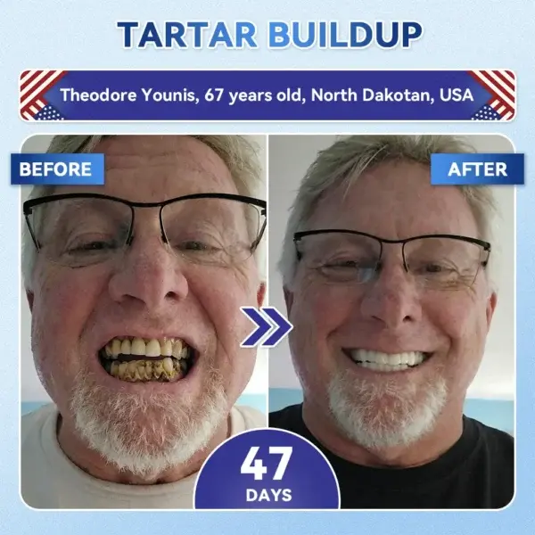Your Smile~ ๐ฆท Tideglusib FastโDissolving Tooth & Gum Repair Oral Strips โจ (๐-๐ข๐ง-๐ ๐ ๐๐๐๐ฎ๐ข๐ฅ๐ ๐๐ง๐๐ฆ๐๐ฅ & ๐๐๐ง๐ญ๐ข๐ง โข ๐๐ญ๐ซ๐๐ง๐ ๐ญ๐ก๐๐ง ๐๐ฎ๐ฆ๐ฌ โข ๐๐ซ๐๐๐ข๐๐๐ญ๐ ๐๐๐ซ๐ญ๐๐ซ & ๐๐๐จ๐ซ โข ๐๐ก๐ข๐ญ๐๐ง๐ข๐ง๐ โข ๐๐ญ๐จ๐ฉ ๐๐จ๐จ๐ญ๐ก ๐๐๐ง๐ฌ๐ข๐ญ๐ข๐ฏ๐ข๐ญ๐ฒ) - Image 4