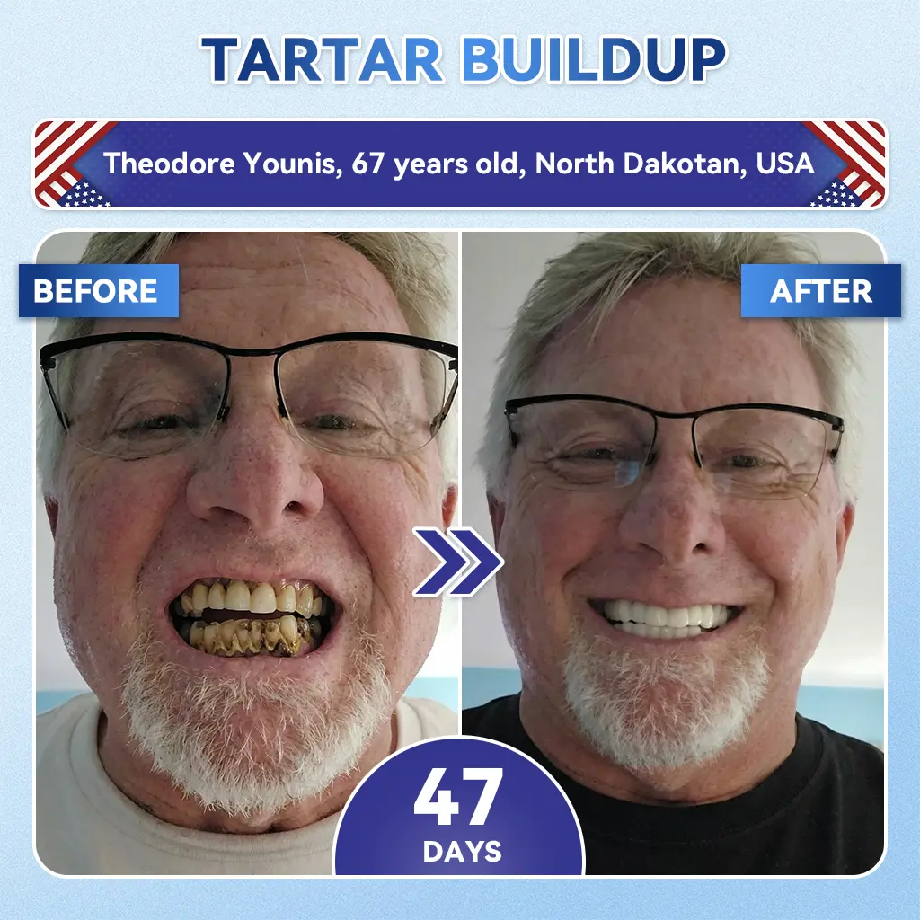 Your Smile~ ๐ฆท Tideglusib FastโDissolving Tooth & Gum Repair Oral Strips โจ (๐-๐ข๐ง-๐ ๐ ๐๐๐๐ฎ๐ข๐ฅ๐ ๐๐ง๐๐ฆ๐๐ฅ & ๐๐๐ง๐ญ๐ข๐ง โข ๐๐ญ๐ซ๐๐ง๐ ๐ญ๐ก๐๐ง ๐๐ฎ๐ฆ๐ฌ โข ๐๐ซ๐๐๐ข๐๐๐ญ๐ ๐๐๐ซ๐ญ๐๐ซ & ๐๐๐จ๐ซ โข ๐๐ก๐ข๐ญ๐๐ง๐ข๐ง๐ โข ๐๐ญ๐จ๐ฉ ๐๐จ๐จ๐ญ๐ก ๐๐๐ง๐ฌ๐ข๐ญ๐ข๐ฏ๐ข๐ญ๐ฒ) - Image 4