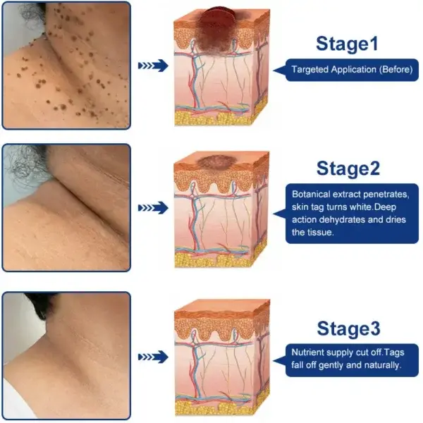 Targeted Skin Tag & Wart Removal Cream – Time-Released Phyto-Exfoliant (12% Celandine ) & Bio-Active Terpene Viral-Inhibitor (8% Thuja) - Image 2