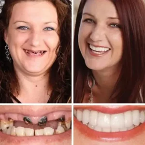 -Ends Today: 70% OFF! Full Denture with Strong Suctiond Custom-Fit Full Functional Dentures🦷 - Image 7