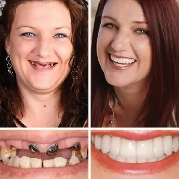-Ends Today: 70% OFF! Full Denture with Strong Suctiond Custom-Fit Full Functional Dentures🦷 - Image 7