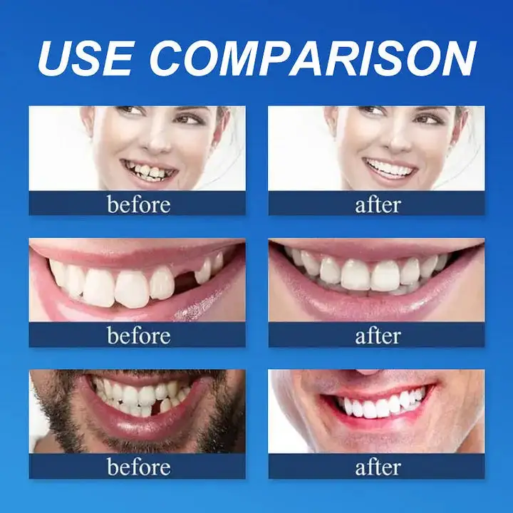-Ends Today: 70% OFF! Full Denture with Strong Suctiond Custom-Fit Full Functional Dentures🦷 - Image 5