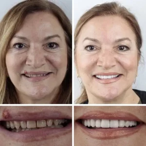 --Ends Today: 75% OFF! Full Denture with Strong Suctiond Custom-Fit Full Functional Dentures🦷 - Image 12