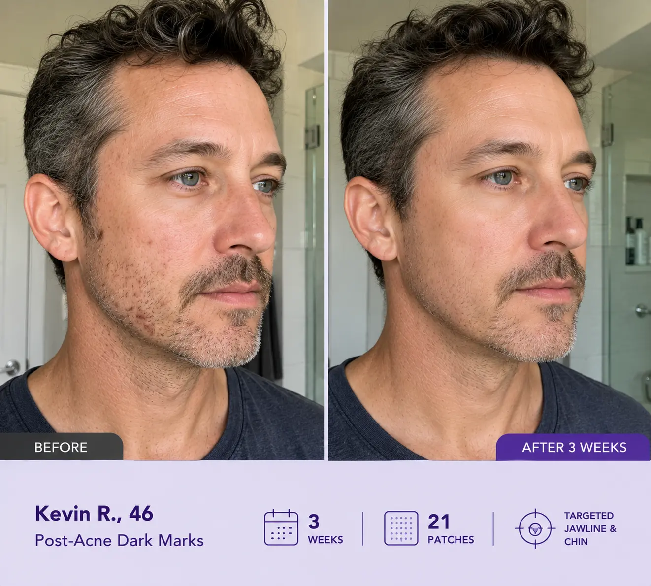 Leanviy Dark Spot Removal Patch|Nano Microneedle Technology · Visible Results in 7 Days - Image 4