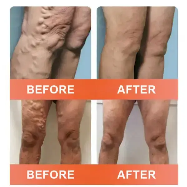Vein Ease Microneedle Care Patch - Image 7