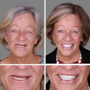 🦷Custom-Fit Dentures | Smile with Confidence - Image 11