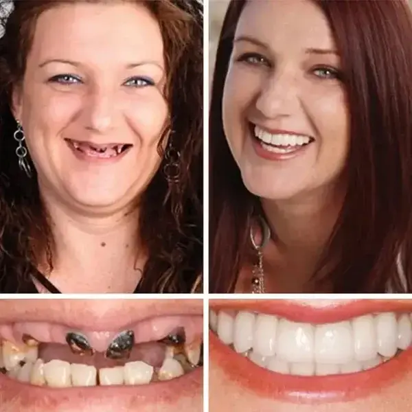 🦷Custom-Fit Dentures | Smile with Confidence - Image 10