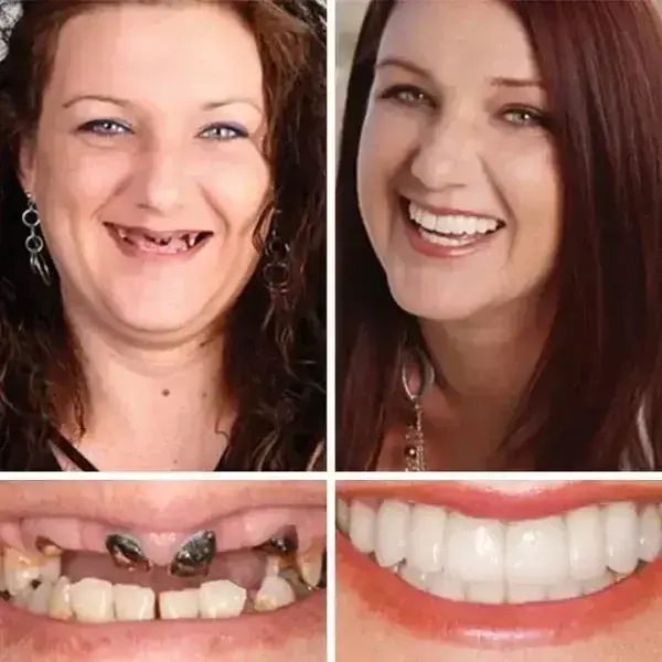 -Ends Today: 70% OFF! Full Denture with Strong Suctiond Custom-Fit Full Functional Dentures🦷 - Image 6