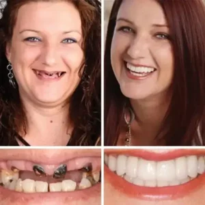 -Ends Today: 70% OFF! Full Denture with Strong Suctiond Custom-Fit Full Functional Dentures🦷 - Image 7