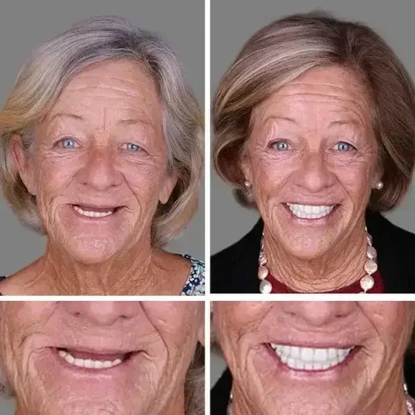 -Ends Today: 70% OFF! Full Denture with Strong Suctiond Custom-Fit Full Functional Dentures🦷 - Image 5