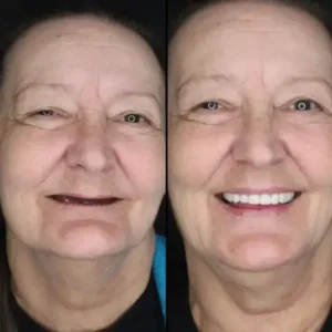 Alternative view of 【Official Brand CustomFit Functional Dentures — Combination pack